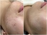 【人気NO.1！】敏感肌でも◎ヒト幹細胞フェイシャルで肌質改善★ニキビケア◎