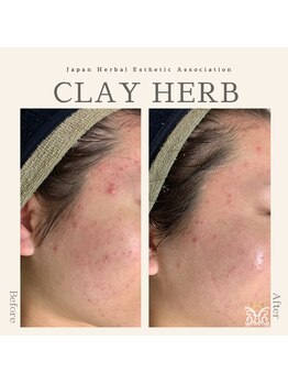 スリジエ ボーテ(cerisierBEAUTE)/施術1回の結果☆ニキビケアに◎