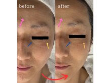 奏の雰囲気（1回の施術、50代のお客様。おでこや目元のシワに変化が☆）
