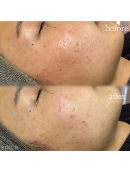 スピカ(Spica)/ハーブ&毛穴洗浄&幹細胞