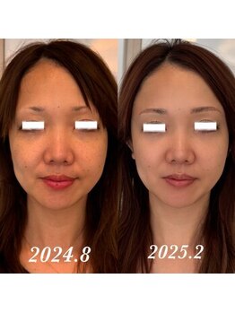 ティアラ(TIARA)/【小顔、たるみ】テラボーラー