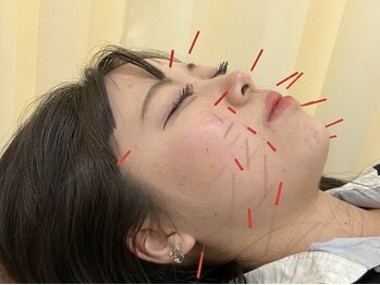 さかもと鍼灸整骨院/美容鍼でむくみ解消☆小顔