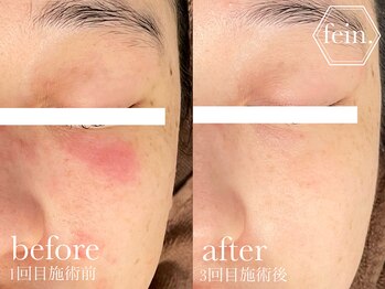 フェイン 青山店(fein.)/お肌の土台を整えます♪
