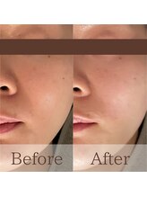 凪眠/小顔リンパフェイシャルの効果49