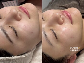 サロンベイア(salon Beia)/美肌waxビフォアフ