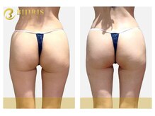 きりん接骨鍼灸院 尼崎武庫之荘店/【ビジリス】お尻のたるみ