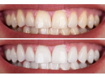 ユニクリア(Uni clear)/最新◆ホームホワイトニング