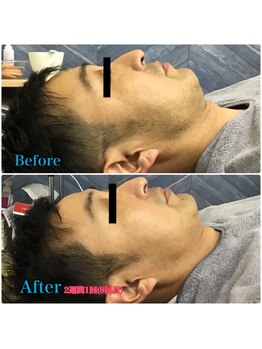 エステルーム ココ(COCO)の写真/男前への近道！メンズ脱毛デビューで、憧れの美肌を手に入れよう◎