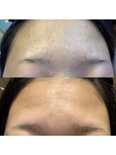 ブランシェ 高岡店 × 椿/リアージュセラム使用前後