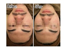 アクアプラス(AQUA+)/陶肌トリートメント20代男性