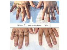 ネイルサロン ラグゼ(Nail salon Luxe)/深爪改善コース