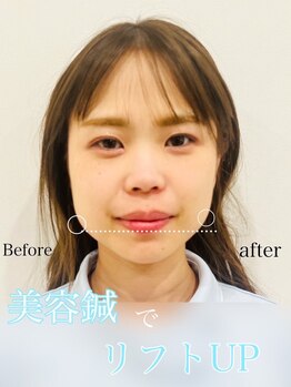 赤沼鍼灸整骨院/美・健康・笑顔に導く美容鍼