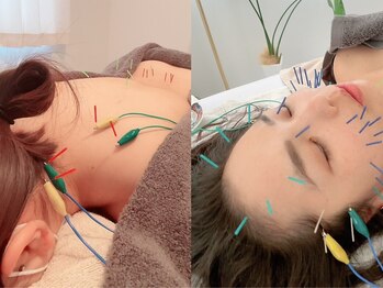 鍼グリッター 岡山本院(鍼Glitter.)の写真/【お友達・カップルで美容鍼★】メンズ・ペア利用OK！フェイスラインすっきり・小顔効果◎プレゼントにも♪