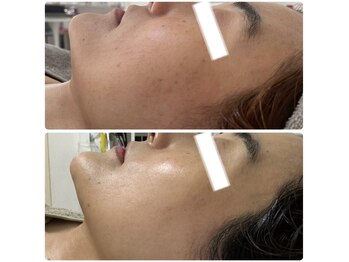 エステサロンブランシュ(Esthe salon Blanche)/くすみとシミにハーブピーリング