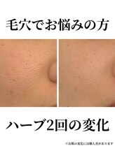 イーオ(io)/毛穴の開きが…