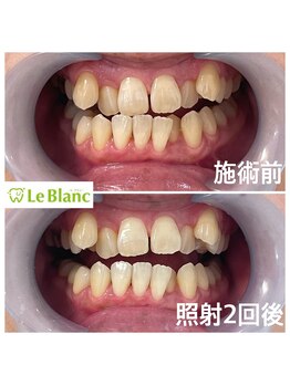 ルブラン 奈良店(Le Blanc)/ホワイトニングに興味ある方