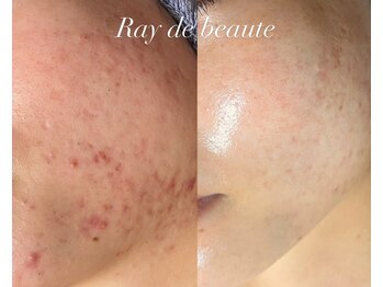 レイドボーテ(Ray de beaute)/繰り返す肌荒れ収束