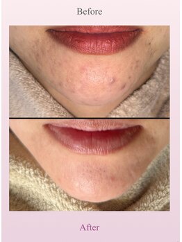 アディス 心斎橋(ADISE)/プラズマでニキビ撲滅