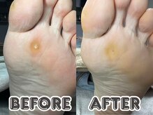 ポドロ ウィズ ニコルル 大阪天満店(PoDoLo with Nicolulu)/【魚の目】フットケア大阪・梅田