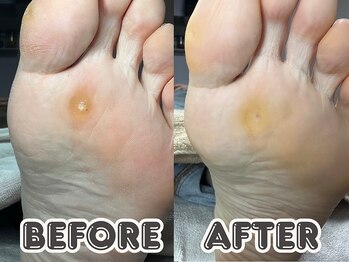 ポドロ ウィズ ニコルル 大阪天満店(PoDoLo with Nicolulu)/【魚の目】フットケア大阪・梅田