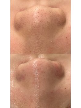 ラルガ 城野店(Raruga)/毛穴洗浄