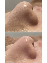 リノ(LINO)/押し出し、吸引なしの毛穴ケア