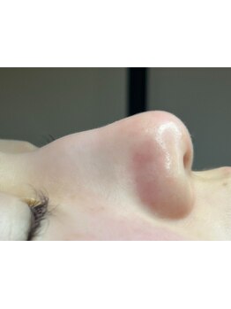 毛穴ケアをしたい