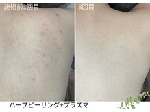 ウェルビー(Well-Be)/ハーブピーリング＋プラズマ導入