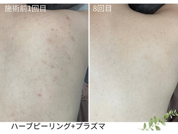ウェルビー(Well-Be)/ハーブピーリング＋プラズマ導入