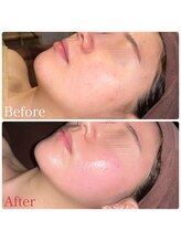 ビューティースタイリング 自由が丘店(beauty styling)/【最新ハーブピーリング】