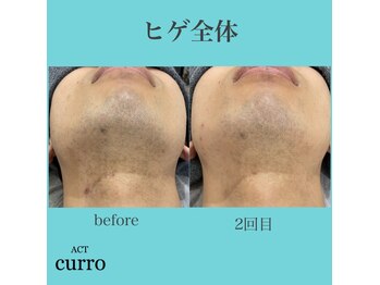 アクト クロ(ACT curro)/【ヒゲ全体】脱毛施術例