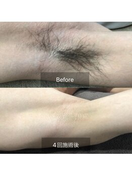 カルナ(CARNA)/ワキ脱毛（4回施術）