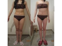 プロラボスパ 池袋東口店/20代後半　痩身症例