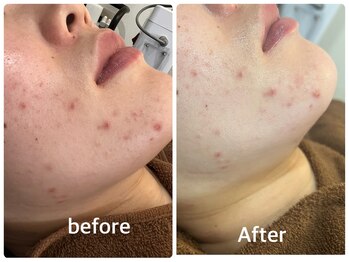 デューン 蕨店(Dune)/フェイシャル/ハーブピーリング