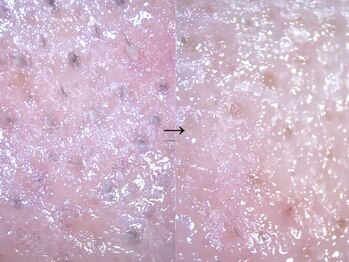 アンティアージュ 福岡本店(antiage)/毛穴の詰まりや開きに