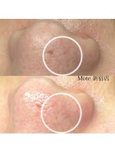 モテ 新宿店(Mote)/ハイドラ毛穴洗浄＋艶肌Wax 新宿