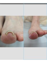 オーキッド/巻き爪矯正後