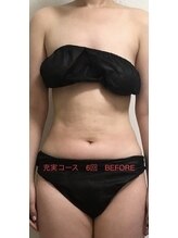 ベルフィーヌ 北千住店(BELFINE)/充実コース 6回 ビフォー 前面