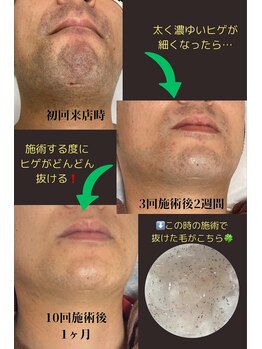長崎駅前脱毛/【ヒゲ脱毛】卒業までの経過