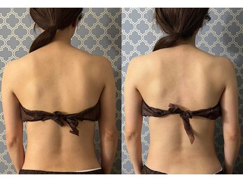 マイティー整骨院 ココア(CoCoa)/肩甲骨洗浄