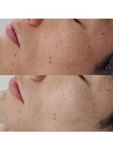 ヴェルシック(Belchic)/乾燥によるシワも改善