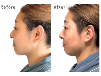 カリド ラボ(CALIDO LAB)/お勧め！インディバフェイシャル