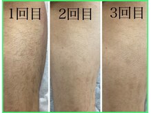 クリア 尾張旭店(Clear)/【Clear脱毛ビフォーアフター】