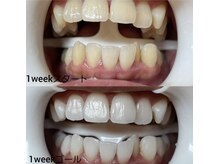 ホワイトニングセンター 那覇新都心店/那覇市・浦添市・ホワイトニング