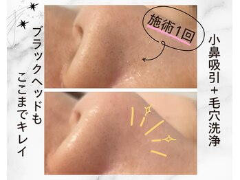 アイリー(iley)/小鼻角栓+毛穴洗浄