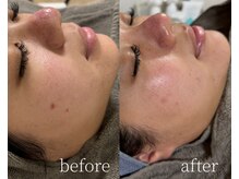 ルーム(lume)/before/after 1ヶ月後