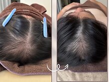 LUNEA/《症例》育毛促進