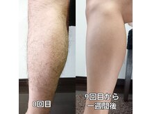 サロンドエーゼット(Salon de AZ)の雰囲気（《ＮＥＷ》男性脱毛9回目の結果！40代）