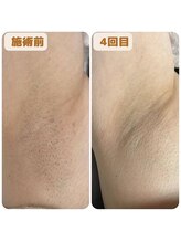 グロウ 脱毛サロン(GLOW)/ワキ脱毛4回目