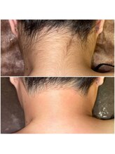 エースタイル(A-style.)/うなじ☆シュガーリング脱毛